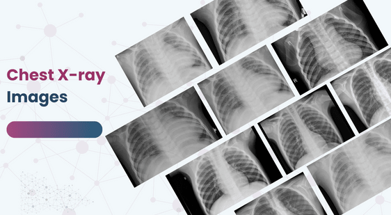Chest X-ray Images