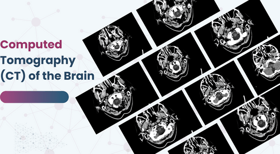 Computed Tomography (CT) of the Brain
