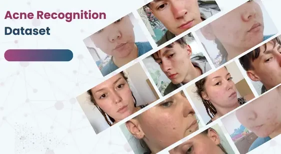 Acne Recognition Dataset