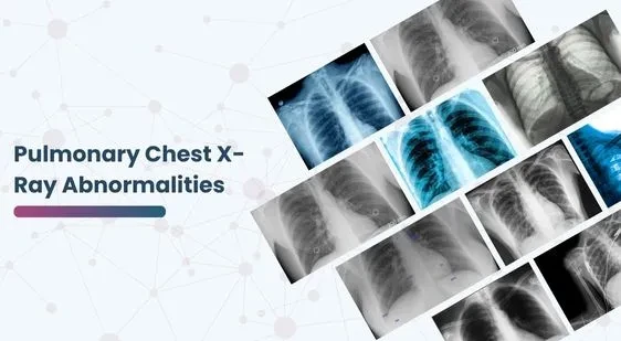 Pulmonary Chest X-Ray Abnormalities | GTS