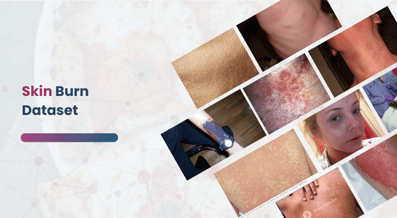 Skin Burn Dataset