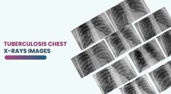 Tuberculosis Chest X-rays Images